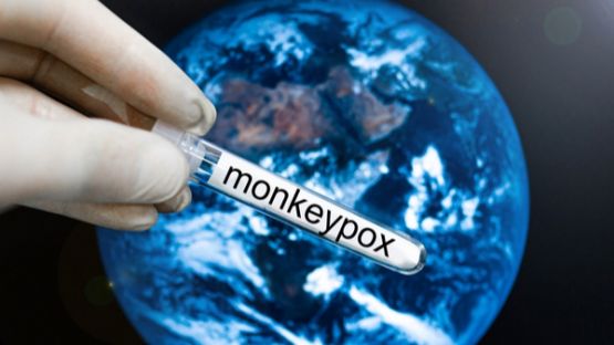 Variole du singe : mobilisation des professionnels de santé